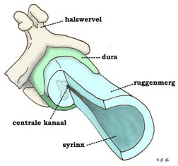 Figuur 4. Schematische weergave van een syrinx in het ruggenmerg