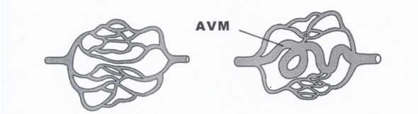 Figuur 1. Schematische weergave van een arterioveneuze malformatie.