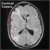 Figuur 1a. MRI, T1 gewogen. Afwijkingen zoals voorkomend bij tubers